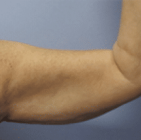 After Image: Arm Lift - 