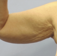 Before Image: Arm Lift - front