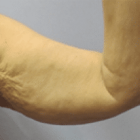 Before Image: Arm Lift - 