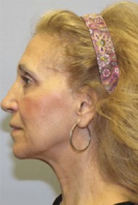 Before Image: Boomer Lift - left-side