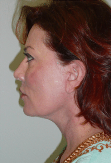 After Image: Boomer Lift - left-side