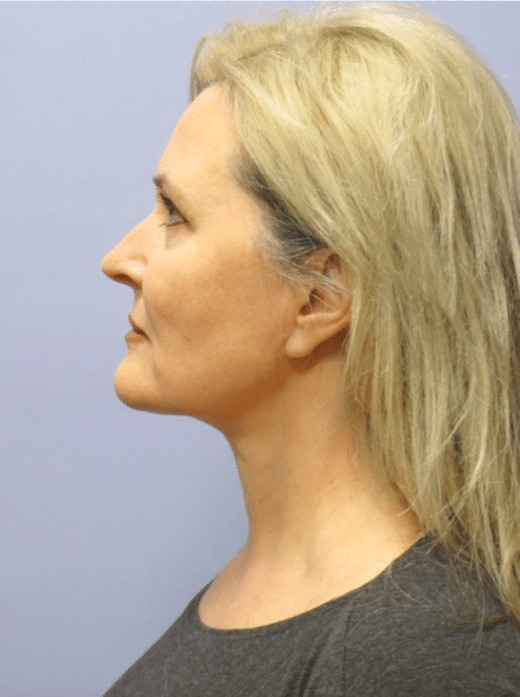After Image: Boomer Lift - left-side