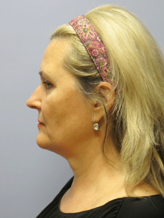 Before Image: Boomer Lift - left-side