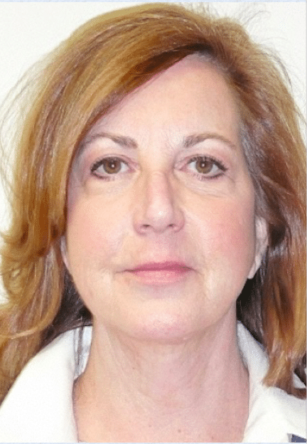 After Image: Boomer Lift - front