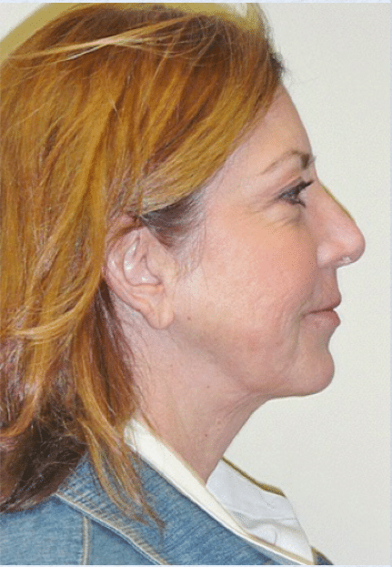 After Image: Boomer Lift - right-side