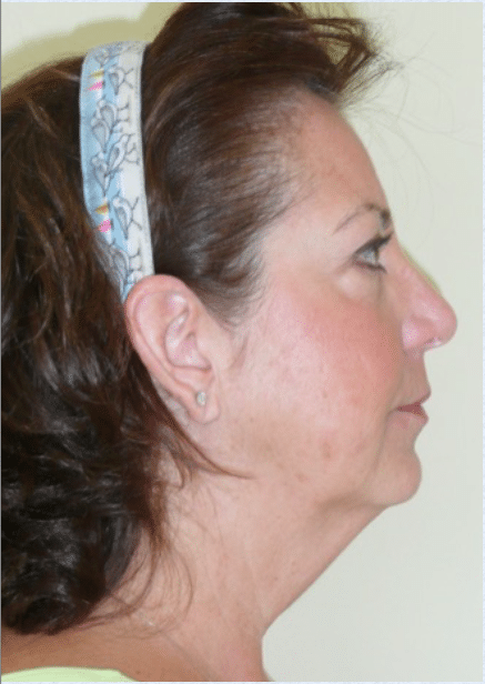 Before Image: Boomer Lift - right-side