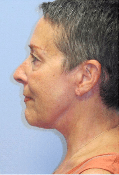 After Image: Boomer Lift - left-side