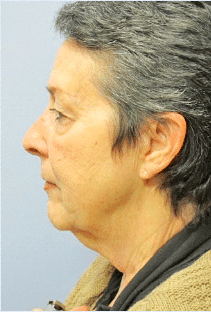 Before Image: Boomer Lift - left-side