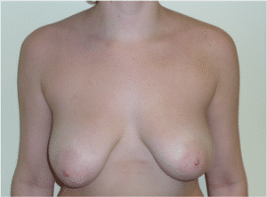 Before Image: Breast Lift