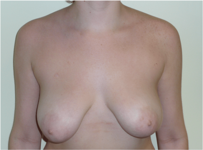 Before Image: Breast Lift - front