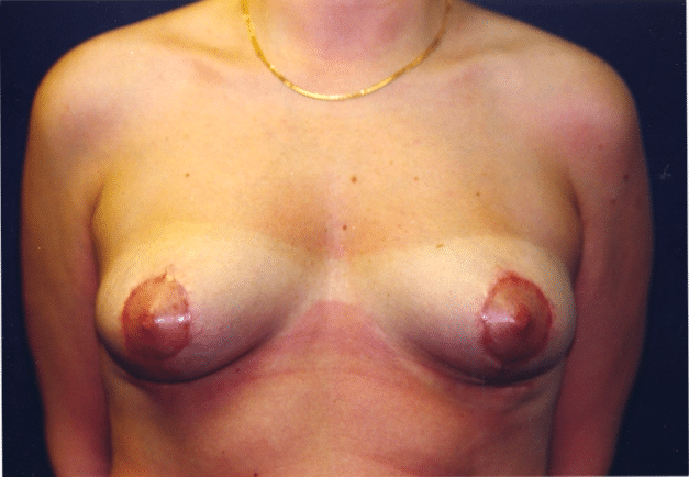 After Image: Breast Lift - front