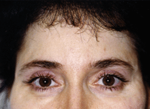 After Image: Brow Lift