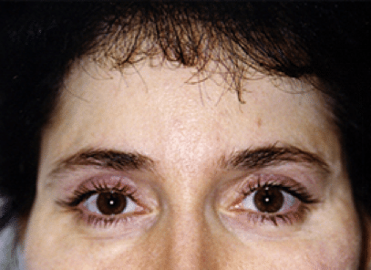 After Image: Brow Lift - front