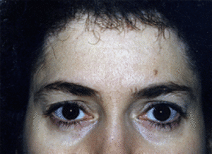 Before Image: Brow Lift