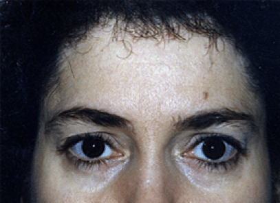 Before Image: Brow Lift - front