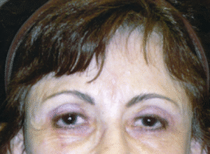 After Image: Brow Lift