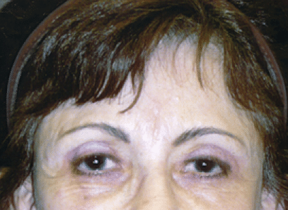 After Image: Brow Lift - front