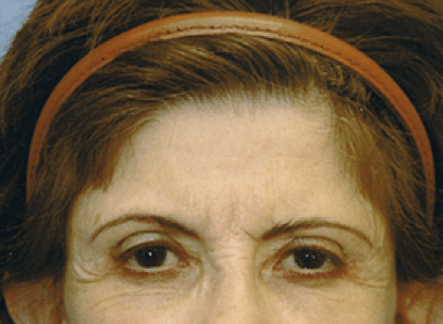 Before Image: Brow Lift - front