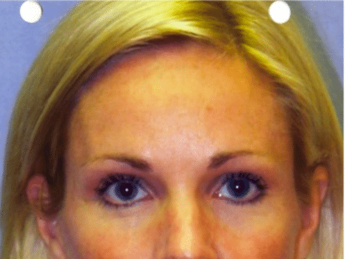 After Image: Brow Lift - front