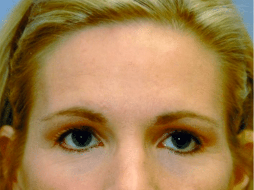 Before Image: Brow Lift - front