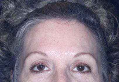 After Image: Brow Lift - front