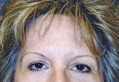 Before Image: Brow Lift - front