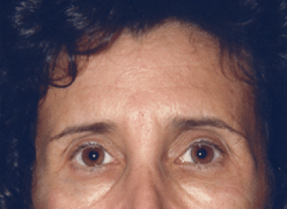 Before Image: Brow Lift - front