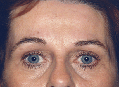 After Image: Brow Lift - front