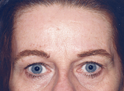 Before Image: Brow Lift - front