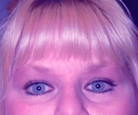 After Image: Brow Lift - front