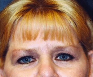 Before Image: Brow Lift