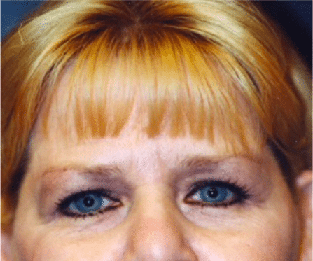 Before Image: Brow Lift - front