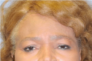After Image: Brow Lift