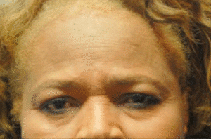 Before Image: Brow Lift