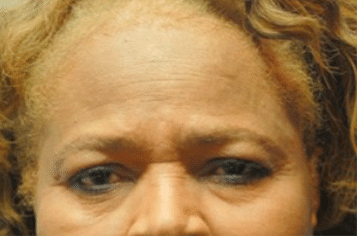 Before Image: Brow Lift - front