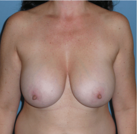 Before Image: Breast Explant - front