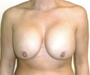 Before Image: Breast Explant - front