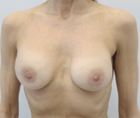 Before Image: Breast Explant - front