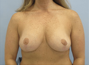 After Image: Breast Explant and Lift