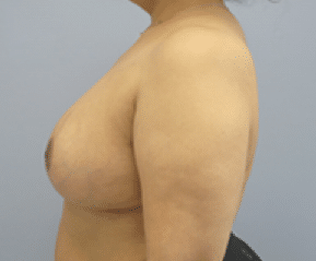 After Image: Breast Explant and Lift - left-side