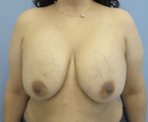 Before Image: Breast Explant and Lift