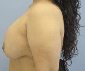 Before Image: Breast Explant and Lift - left-side