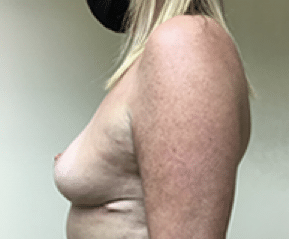 After Image: Breast Explant and Lift - left-side