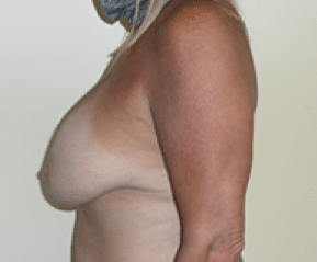 Before Image: Breast Explant and Lift - left-side