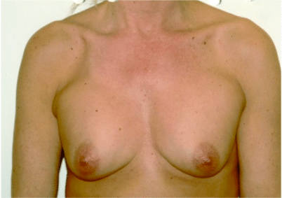 Before Image: Breast Implant Correction - front