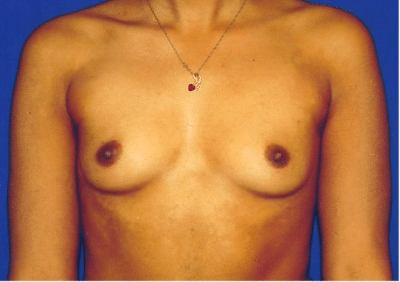Before Image: Breast Implant Correction - front