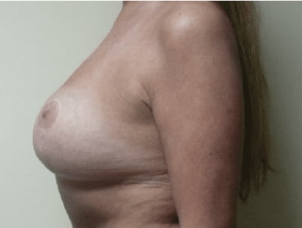After Image: Breast Implant Correction - left-side