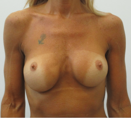 Before Image: Breast Implant Correction - front
