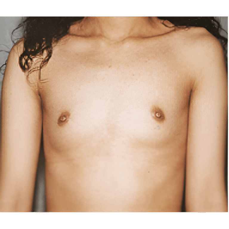 Before Image: Breast Implants - front