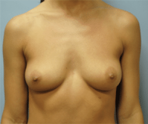 Before Image: Breast Implants - front